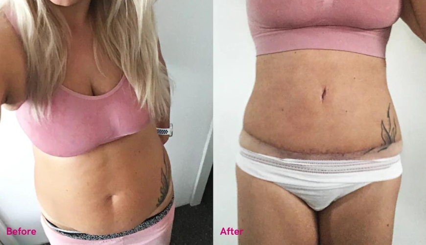 Livia ist zwei Mal in einem rosa BH und Unterhose abgebildet. Links sieht man ihren Bauch mit der Rektusdiastase und rechts das vorläufige Ergebnis nach der Bauchdeckenstraffungs-OP mit relativ frischer Narbe am Unterbauch.