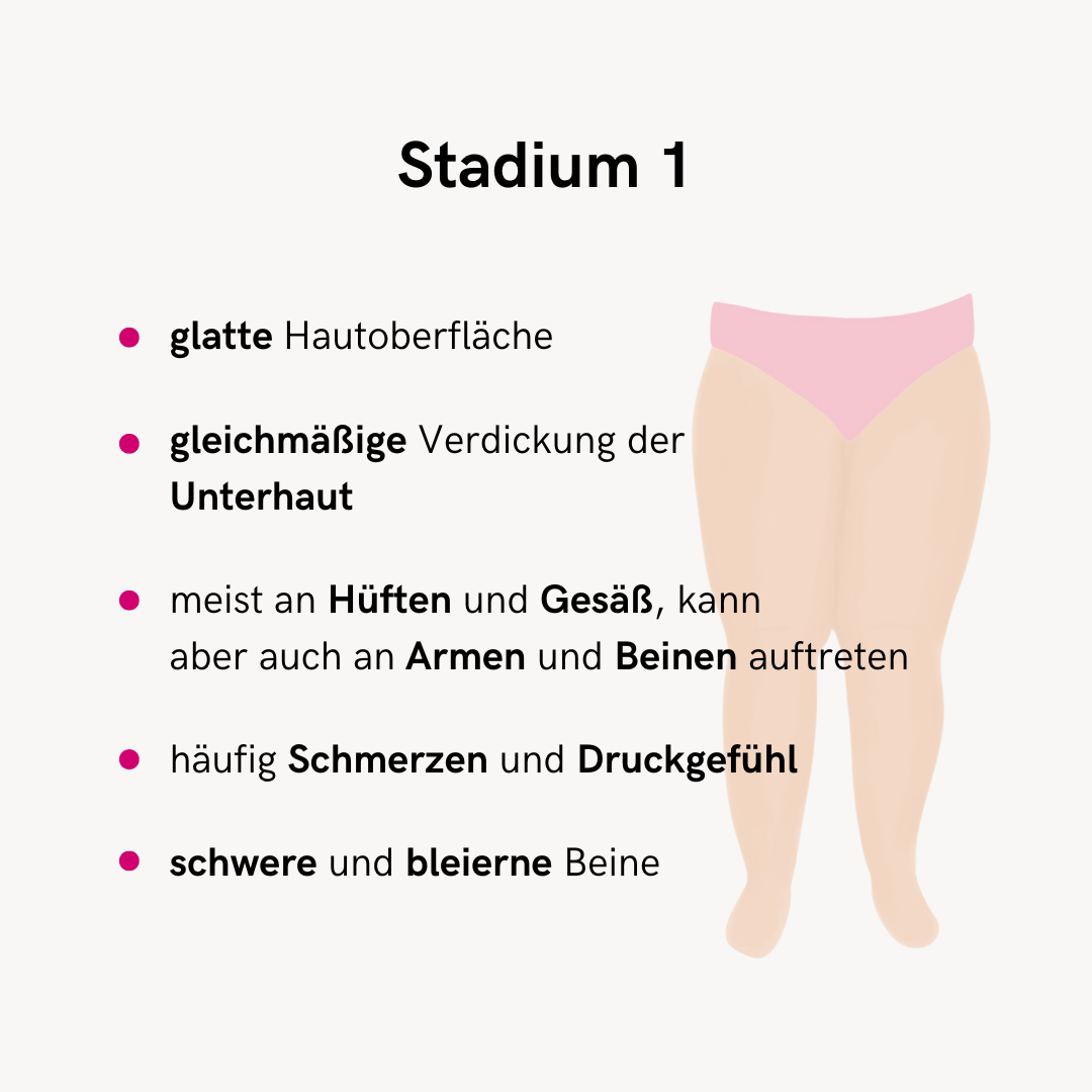 Bei Lipödem Stadien werden vor allem drei Lipödem Stadien genannt, diese unterscheiden sich in den Lipödem Symptomen.  