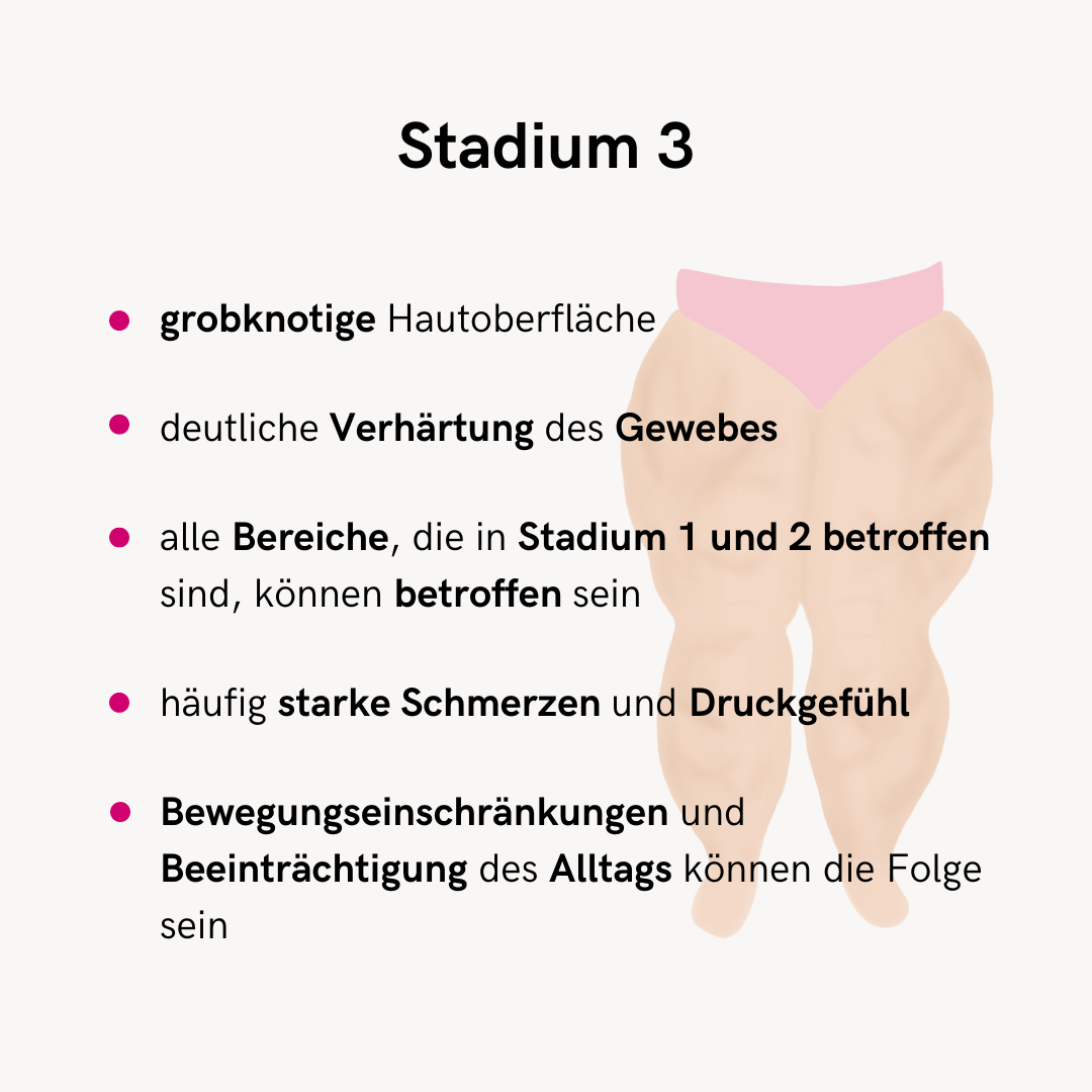 Bei Lipödem Stadien werden vor allem drei Lipödem Stadien genannt, diese unterscheiden sich in den Lipödem Symptomen.  